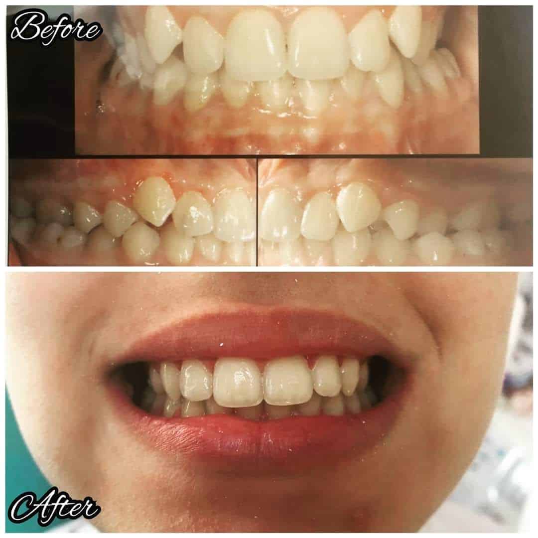 Rezultat ortodonție 1