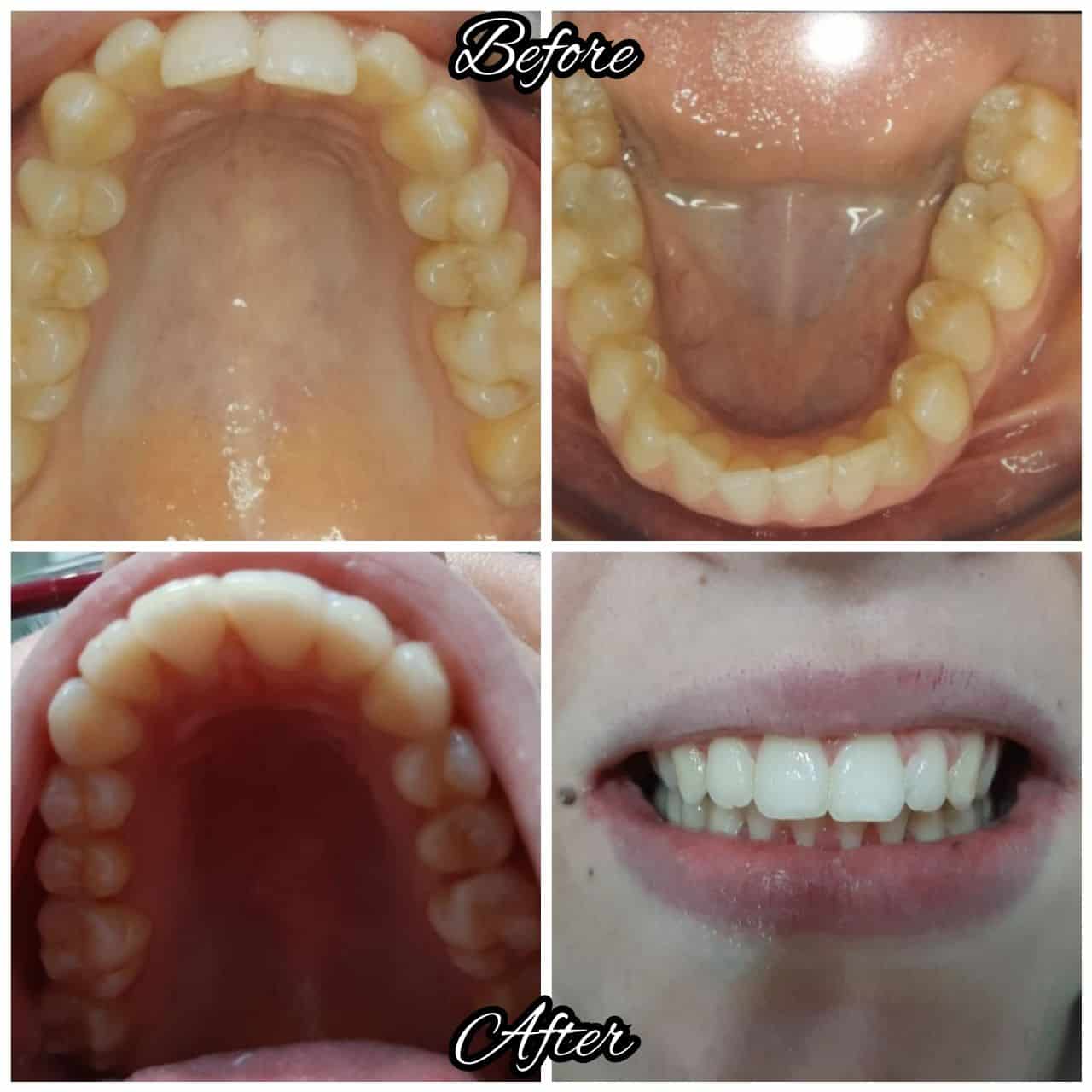 Rezultat ortodonție 3