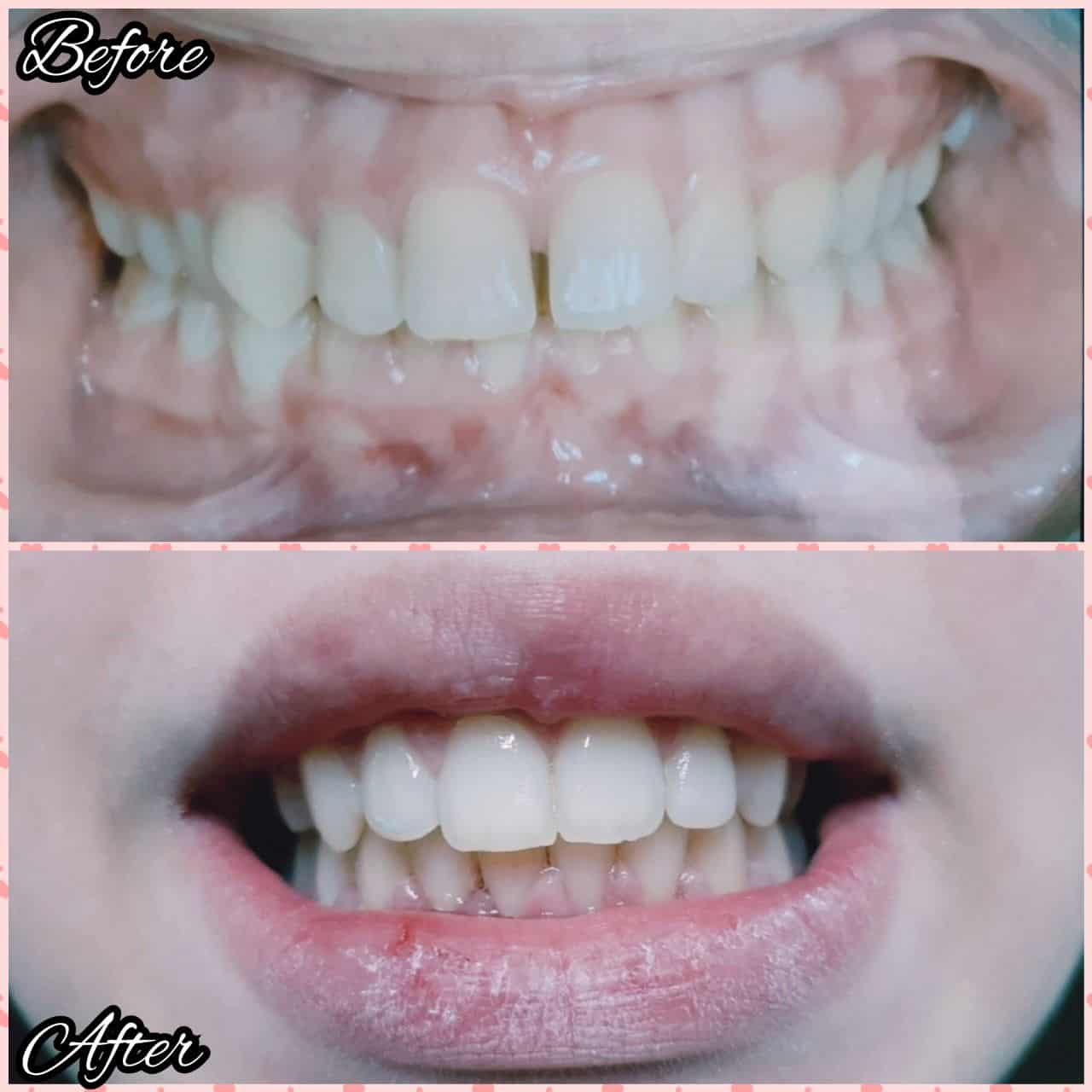 Rezultat ortodonție 5